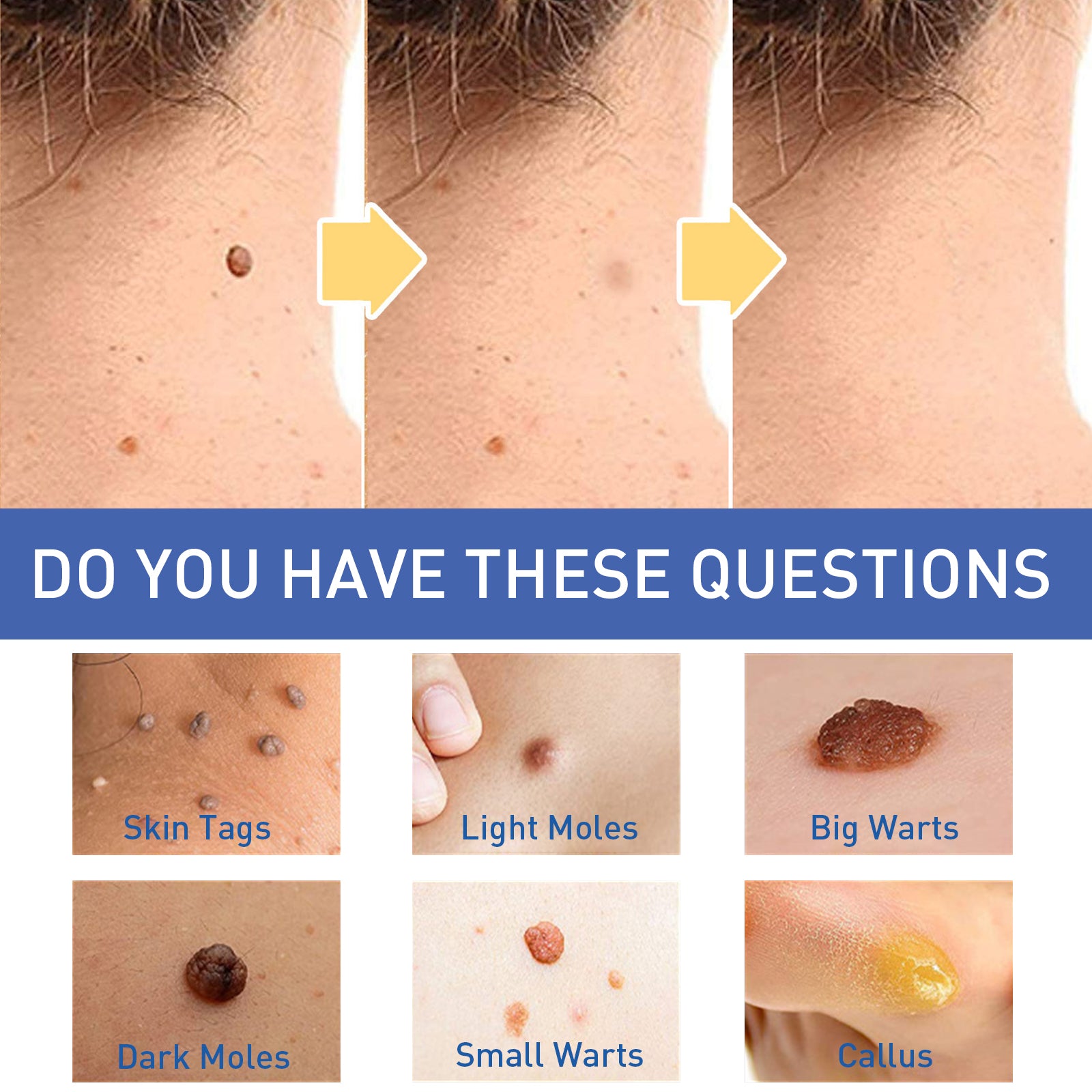 Warts Remover Cream, Body Skin Gram Wart Mole Meat Ball Wart Gentle Clean Smooth Skin