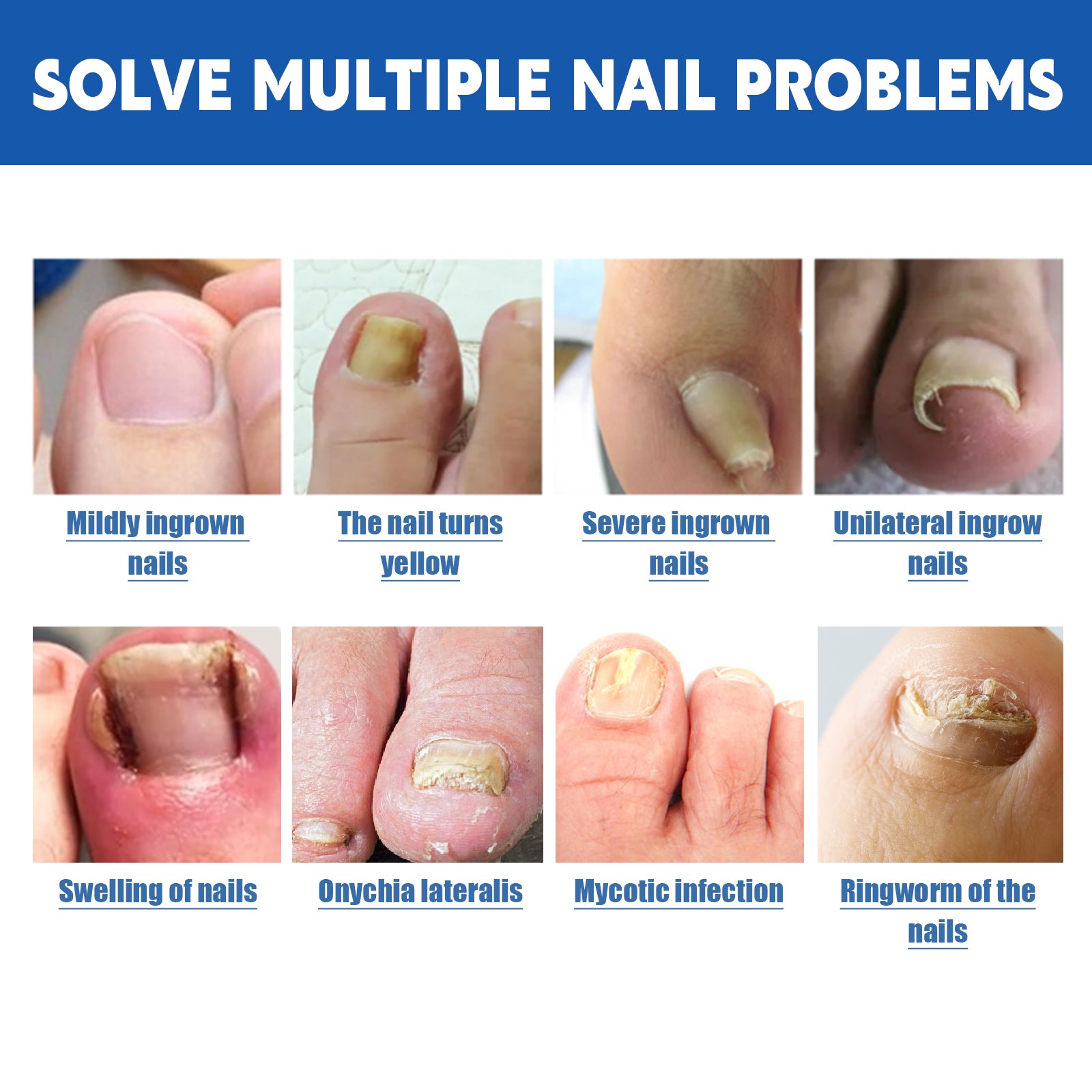 Nail Seam Care Patch, Repair Thickening Gray Nail Soft Nail Correction Nail Seam Patch